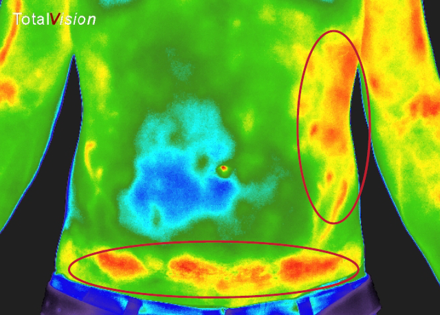 Why Thermography for Health Monitoring